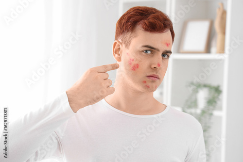 Teenage boy with acne in ba...