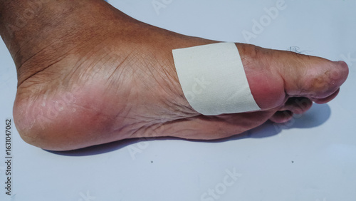 Cover the feet with white patch. The patch helps with foot injuries and protects the wound from dirt.