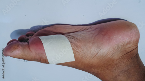 Cover the feet with white patch. The patch helps with foot injuries and protects the wound from dirt.