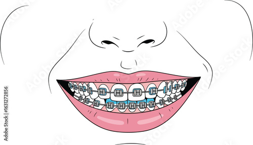 Cartoon mouth with braces dental care orthodontics illustration editable