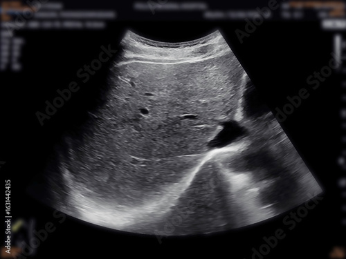 A normal ultrasound of the upper abdomen, showing healthy organs with no abnormalities. Clear imaging of the liver, pancreas, and surrounding structures.