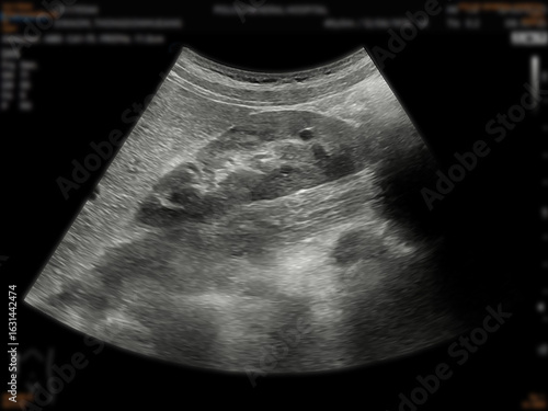 A normal ultrasound of the upper abdomen, showing healthy organs with no abnormalities. Clear imaging of the liver, pancreas, and surrounding structures.