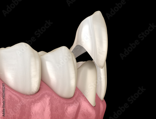 Photos Dental veneer placement on canine teeth. 3D illustration