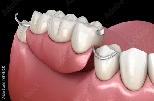 Dental bridge based on gum and connectors. 3D illustration