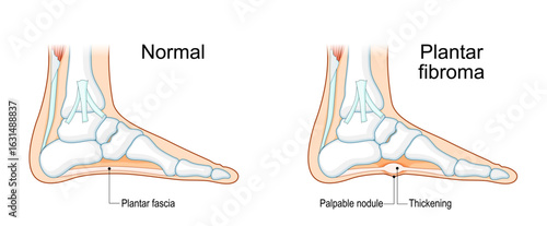 Plantar fascial fibromatosis. Plantar fibroma