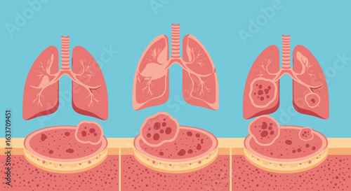 Lung Cancer Medical Illustration Progression Therapy Concept