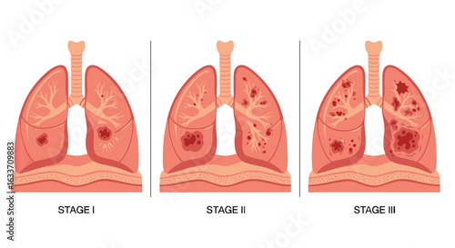 Human Lungs Disease Progression Medical Infographic
