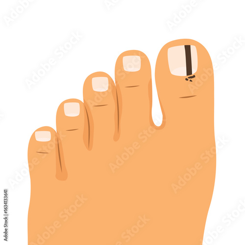toenail affected by melanoma; educational medical graphic ideal for dermatology awareness, skin cancer prevention materials, and healthcare presentations- vector illustration