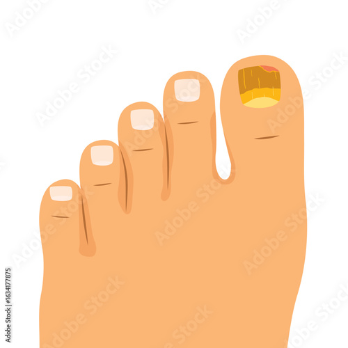toenail affected by fungal infection, showing discoloration, thickening, and nail damage; perfect for educational materials, medical articles, and dermatology awareness content- vector illustration