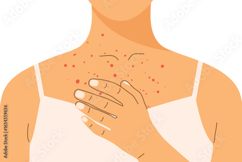 woman with skin rash, allergic reaction on her neckline; ideal for medical, dermatological, and allergy-related educational or promotional content- vector illustration