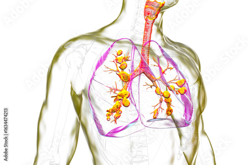 Fotografía Lungs affected by cystic fibrosis, illustration