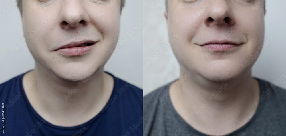 custom made wallpaper toronto digitalBefore and after comparison of a young person with facial nerve palsy (Bell’s palsy). Concept of neurology, recovery, treatment success, and medical