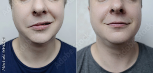 Before and after comparison of a young person with facial nerve palsy (Bell’s palsy). Concept of neurology, recovery, treatment success, and medical