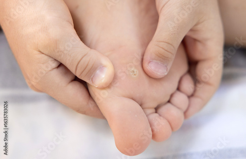 Child with callus on foot and toe lies on blanket. Parent applies adhesive bandage as treatment. Close-up of blister or corn care. Foot care and family support at home, natural light.