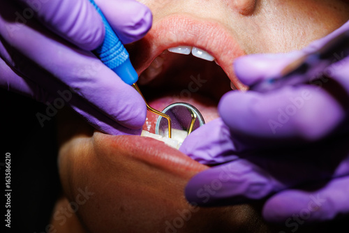 Εκτύπωση καμβά Dental scaling procedure for plaque removal, Close-up of a dentist performing dental scaling to remove plaque and tartar from a patient’s teeth using professional tools