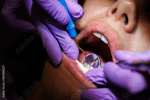 Canvas Print Dental scaling procedure for plaque removal, Close-up of a dentist performing dental scaling to remove plaque and tartar from a patient’s teeth using professional tools
