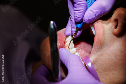 Fototapete Dental scaling procedure for plaque removal, Close-up of a dentist performing dental scaling to remove plaque and tartar from a patient’s teeth using professional tools