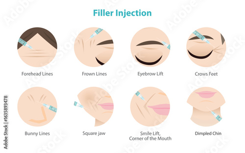Dermal filler injection on woman face vector icon set illustration. Icon set of filler injection areas Forehead, Bunny, Frown lines, Crows feet, Eyebrow lift, Square jaw, Smile lift and Dimpled chin.