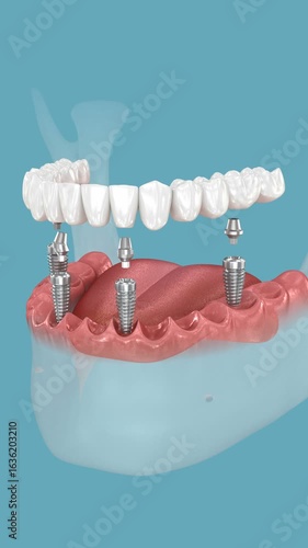 Dental prostheses supported by 4 implants. 3D animation