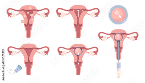Female uterus. Common types of uterine fibroids,  fertilized egg. Educational medical diagram for use in infographics on gynecology, women's health, and the reproductive system. 