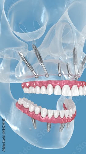 Dental prosthesis supported by zygomatic implants. 3D illustration