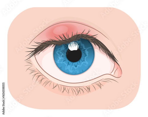 Eye with external barley on the upper eyelid. Medical vector illustration. 