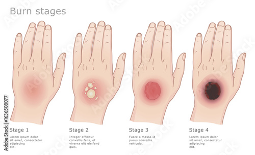 Four stages of the skin burns. Medical vector illustration. 
