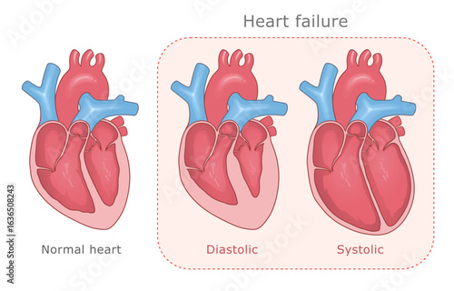Normal heart and two types of heart failure: diastolic and systolic. Vector medical illustration.