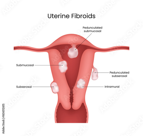 Uterine Fibroids Types and Locations