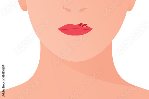 herpes simplex virus on the lips; contagious cold sore symptoms, lip blister, and viral skin infection great for educational, healthcare, and prevention purposes- vector illustration