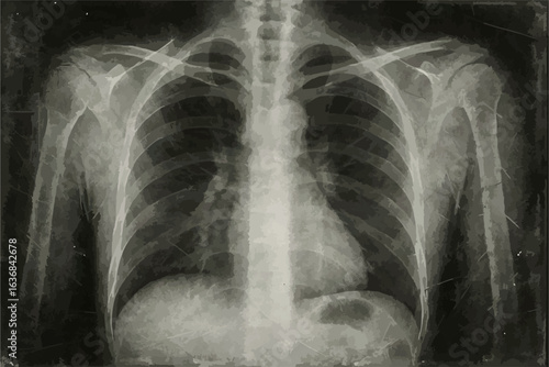 A vintage medical X-ray image showing the chest area, including ribs, spine, and parts of the shoulder joints.