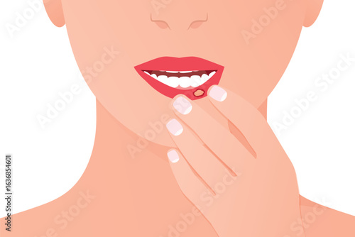 canker sore, aphthous on the lip; medical concept for oral health, inflammation, stomatitis and dermatology education- vector illustration