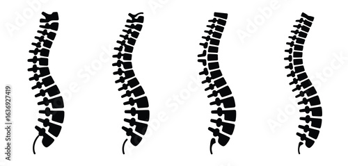 Four silhouettes of human spines showing different curvatures