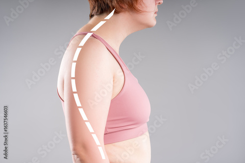 Text neck, stretching exercise for posture, neck pain, cervical spine hernia, woman with curvature of spine on gray background