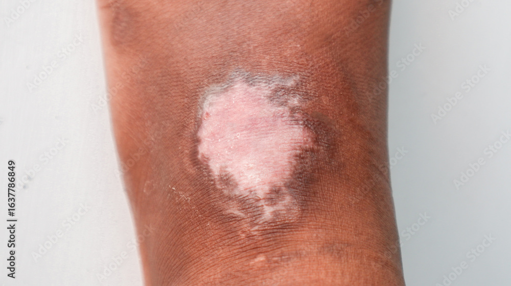 Naklejka premium Legs with visible wound healing patches on top, highlighting the skin condition.