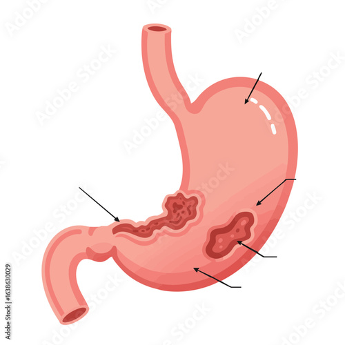 Vector illustration of stomach ulcer diagram on white background, medical concept 