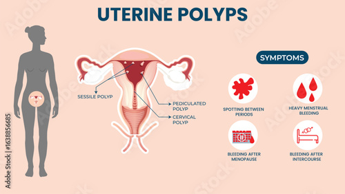 Uterine Polyps Causes Symptoms Diagnosis and Treatment Options