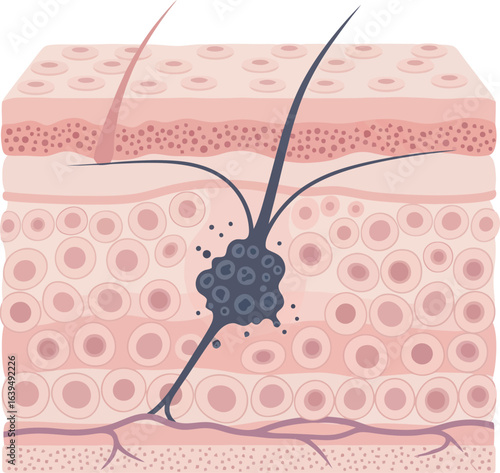 Cross-section illustration of skin layers showing a dark mass within the dermis, connected to a hair follicle.