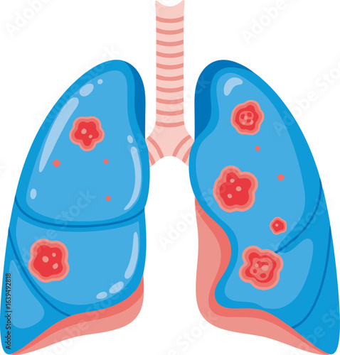 Illustration of human lungs affected by multiple cancerous tumors.