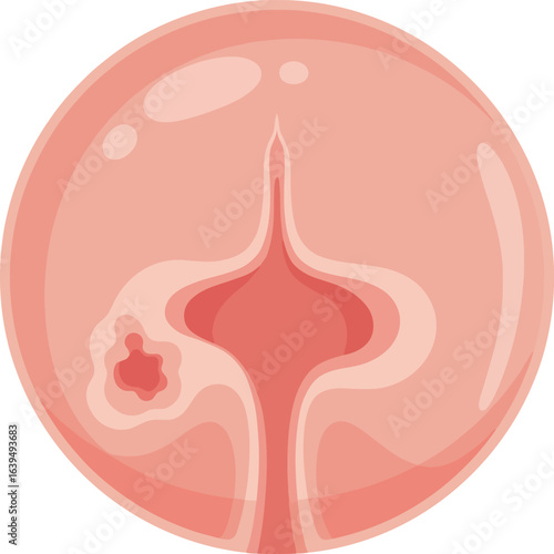 Cross-section illustration of a diseased female reproductive organ, highlighting a lesion.