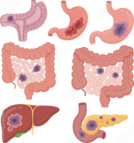 Illustration of digestive system organs with cancerous tumors.