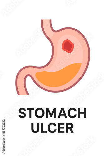 Stomach ulcer illustration in flat design with vibrant colors stomach ulcer diagram