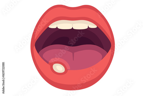Open mouth with visible tongue and dental features in illustration mouth ulcer close-up