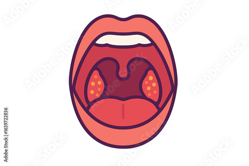 Illustration of human mouth with visible tonsils and uvula inflamed tonsils