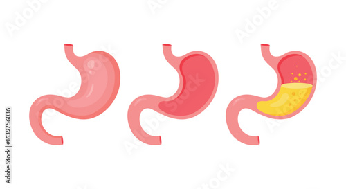 Healthy and unhealthy, empty and full human stomach. Internal organ, anatomy. Internal organ, human gastrointestinal tract. Organ of internal digestion system. Vector illustration in flat style