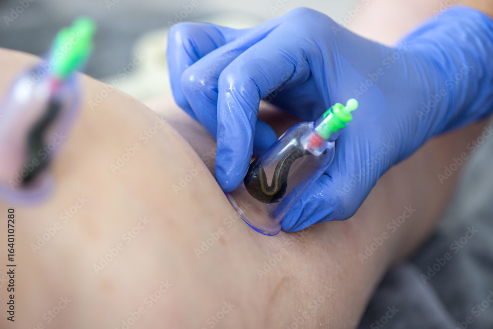 custom made wallpaper toronto digitalHirudotherapy procedure. Doctor applying leech to patient's body. Close-up of doctors hand with leech. Hirudotherapy, Ethnoscience and Alternative medicine. Selective focus.