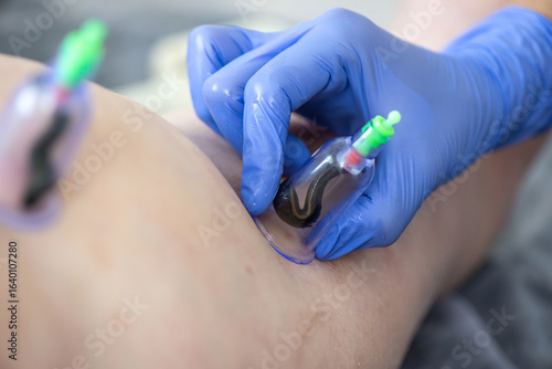 Wallpaper Mural Hirudotherapy procedure. Doctor applying leech to patient's body. Close-up of doctors hand with leech. Hirudotherapy, Ethnoscience and Alternative medicine. Selective focus. Torontodigital.ca