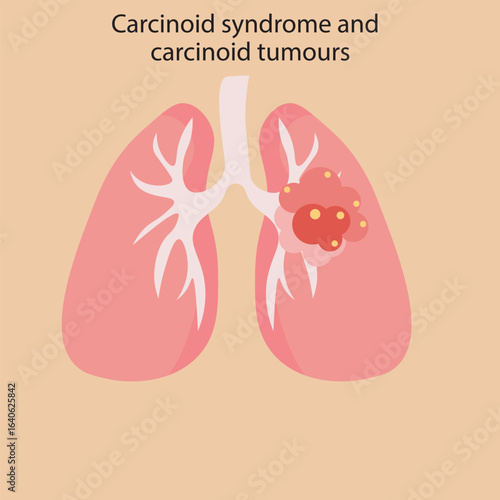 Flat vector illustration of carcinoid syndrome and carcinoid tumors, showing key symptoms like flushing, diarrhea, wheezing, and similar diseases such as IBS and Crohn’s disease. 
