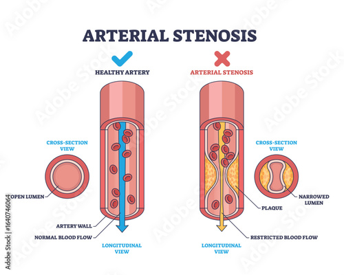 Arterial stenosis is shown by comparing a healthy artery and a narrowed artery with plaque, highlighting restricted blood flow. Outline diagram
