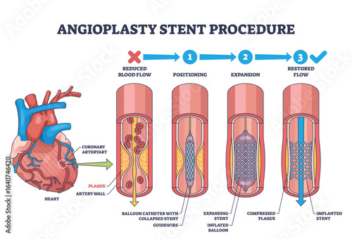 Angioplasty stent procedure shows heart, artery, and stent placement to restore blood flow. Outline diagram